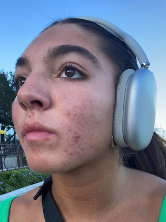 A Thea member on day 1, with breakouts and uneven texture, and again at week 8 with clearer, calmer skin