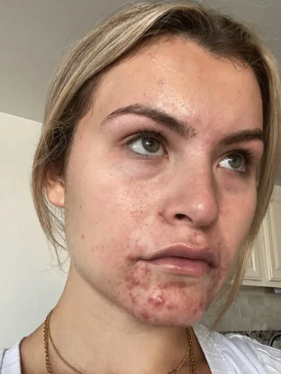 A Thea member with blonde hair on day 1, with breakouts along the chin and jaw, and again at week 8 with clear, even skin