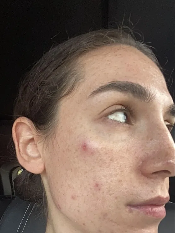 A Thea member with brown hair on day 1, with red breakouts on the cheek, and again at week 8 with clearer, more even skin