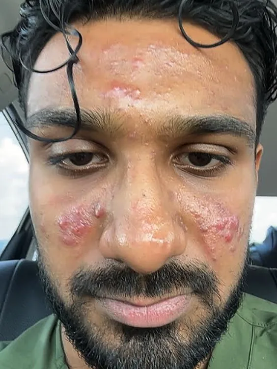 A Thea member on day 1, with red, inflamed breakouts across the forehead and cheeks, and again at week 8 with clear skin